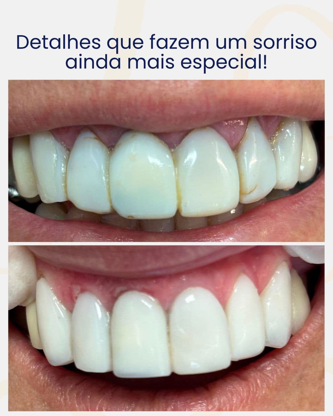 Resultado Antes e Depois - Caso 01 - Dr. Alan Buchmann